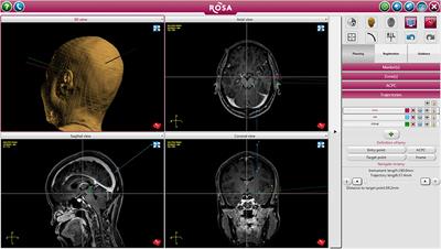 Treatment of Multi-Focal Epilepsy With Resective Surgery Plus Responsive Neurostimulation (RNS): One Institution's Experience